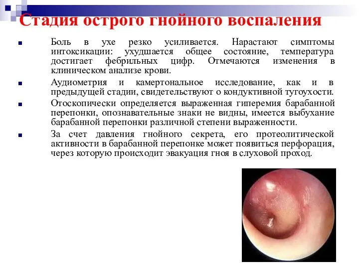 Стадия острого гнойного воспаления Боль в ухе резко усиливается. Нарастают симптомы интоксикации: ухудшается