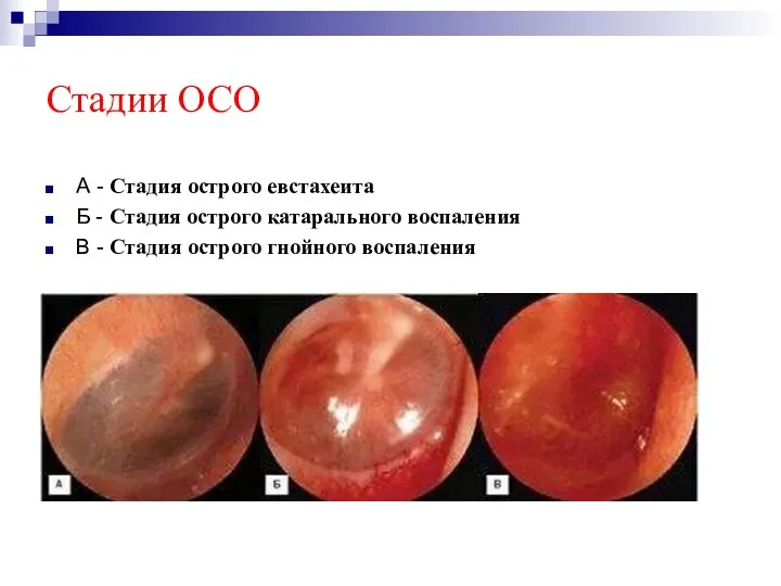 Стадии ОСО А - Стадия острого евстахеита Б - Стадия острого катарального воспаления