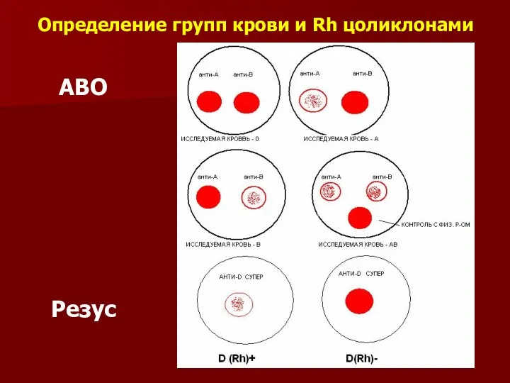 Определение групп крови и Rh цоликлонами АВО Резус