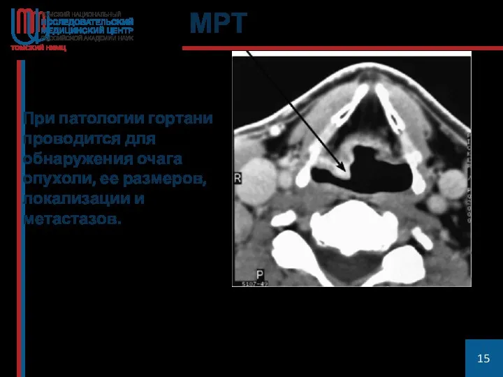 МРТ При патологии гортани проводится для обнаружения очага опухоли, ее размеров, локализации и метастазов.
