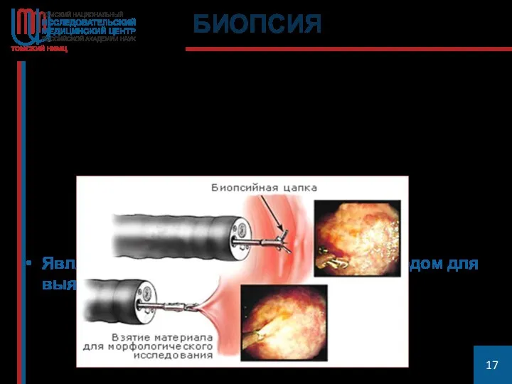 БИОПСИЯ Является основным диагностическим методом для выявления злокачественных опухолей.