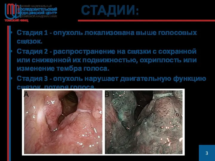 СТАДИИ: Стадия 1 - опухоль локализована выше голосовых связок. Стадия