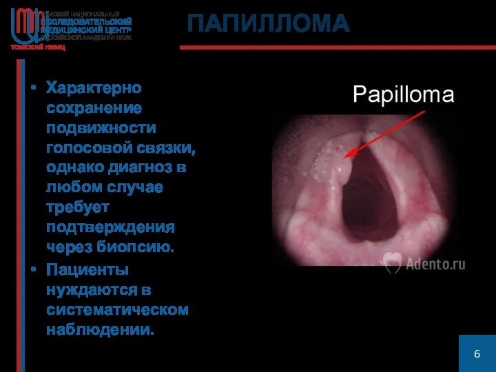 ПАПИЛЛОМА Характерно сохранение подвижности голосовой связки, однако диагноз в любом