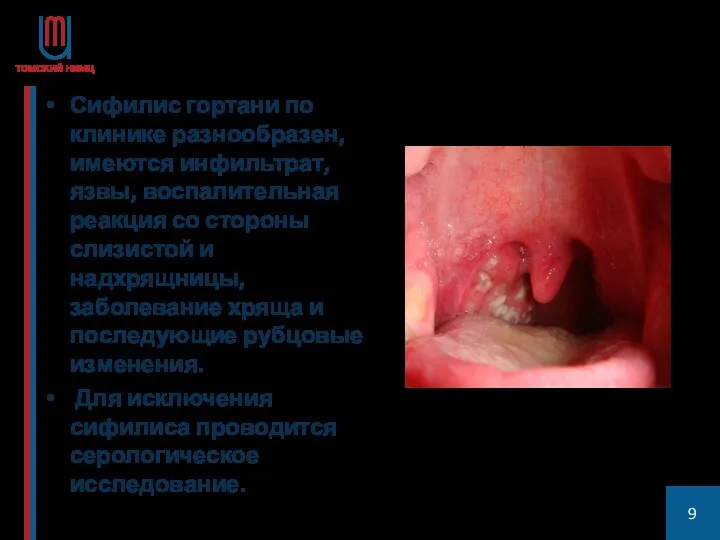 Сифилис гортани по клинике разнообразен, имеются инфильтрат, язвы, воспалительная реакция