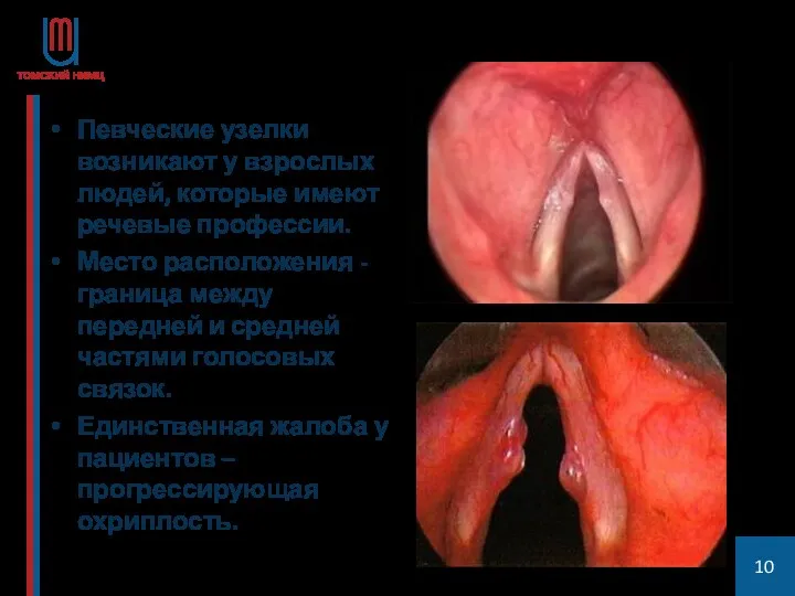 Певческие узелки возникают у взрослых людей, которые имеют речевые профессии.