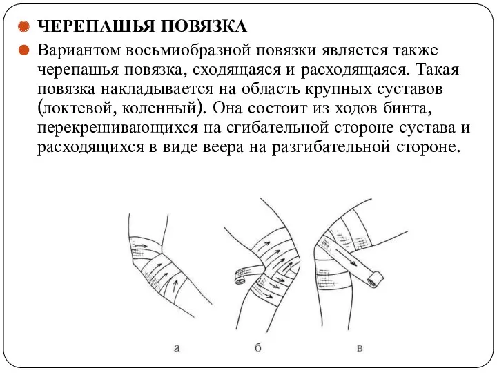 ЧЕРЕПАШЬЯ ПОВЯЗКА Вариантом восьмиобразной повязки является также черепашья повязка, сходящаяся и расходящаяся. Такая