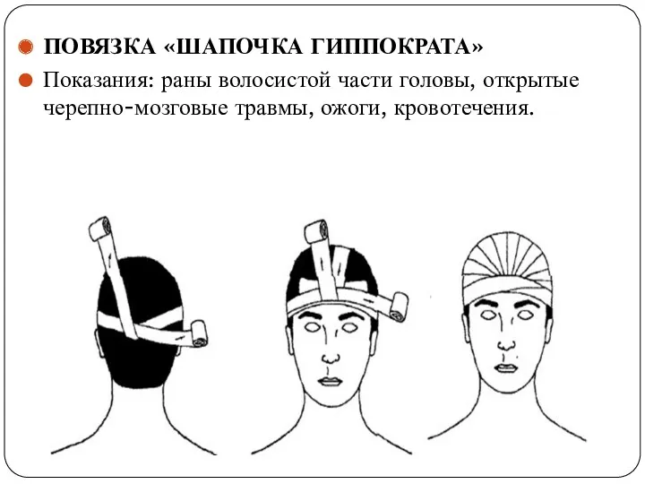 ПОВЯЗКА «ШАПОЧКА ГИППОКРАТА» Показания: раны волосистой части головы, открытые черепно-мозговые травмы, ожоги, кровотечения.