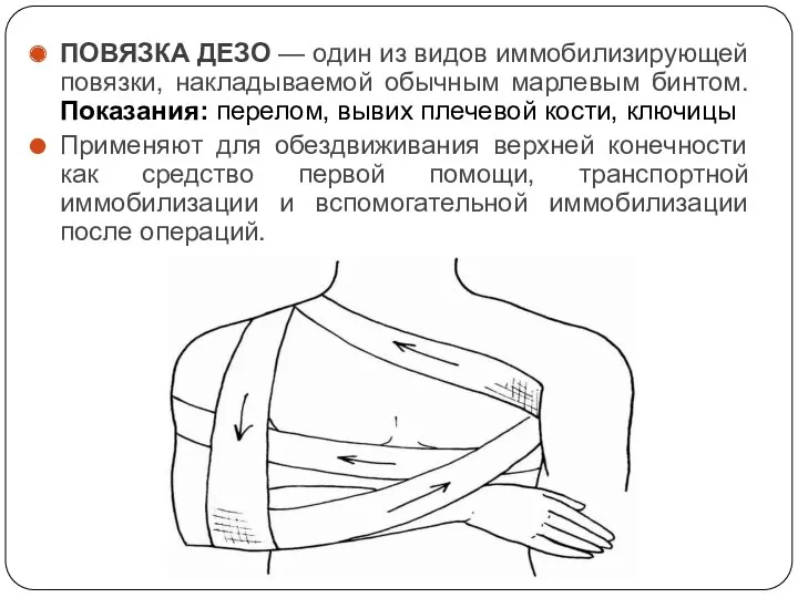 ПОВЯЗКА ДЕЗО — один из видов иммобилизирующей повязки, накладываемой обычным марлевым бинтом. Показания: