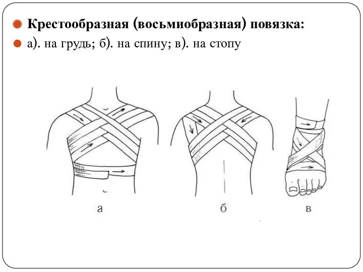 Крестообразная (восьмиобразная) повязка: а). на грудь; б). на спину; в). на стопу