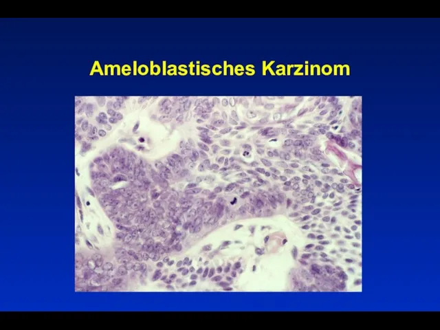 Ameloblastisches Karzinom