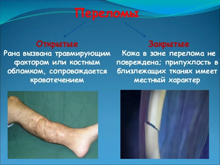 Открытые Рана вызвана травмирующим фактором или костным обломком, сопровождается кровотечением Закрытые Кожа в