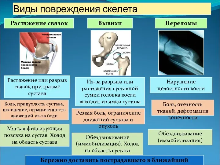 Виды повреждения скелета Растяжение связок Вывихи Переломы Боль, отечность тканей,