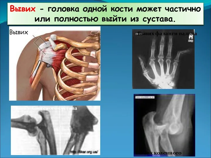 Вывих - головка одной кости может частично или полностью выйти