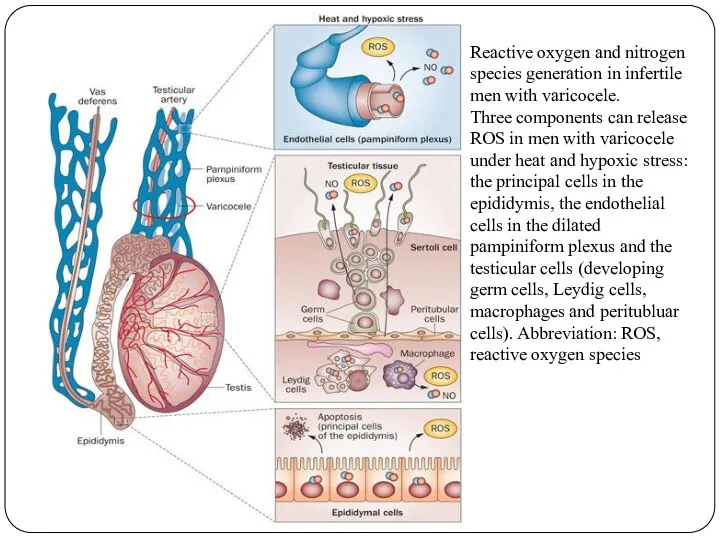 Reactive oxygen and nitrogen species generation in infertile men with