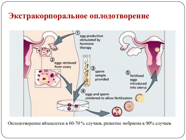 Экстракорпоральное оплодотворение Оплодотворение яйцеклетки в 60-70 % случаев, развитие эмбриона в 90% случаев.