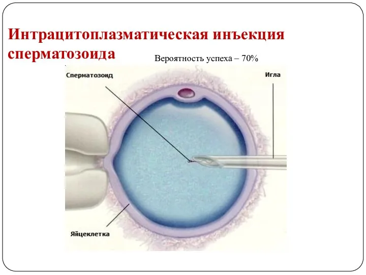 Интрацитоплазматическая инъекция сперматозоида Вероятность успеха – 70%