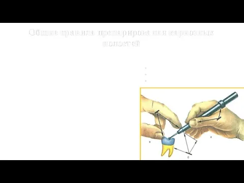 Общие правила препарирования кариозных полостей Одно из важнейших правил препарирования