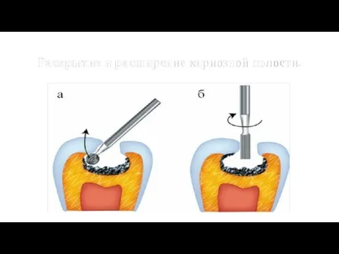 Раскрытие и расширение кариозной полости.