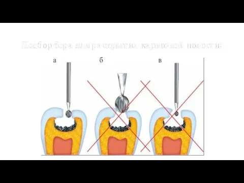 Подбор бора для раскрытия кариозной полости: