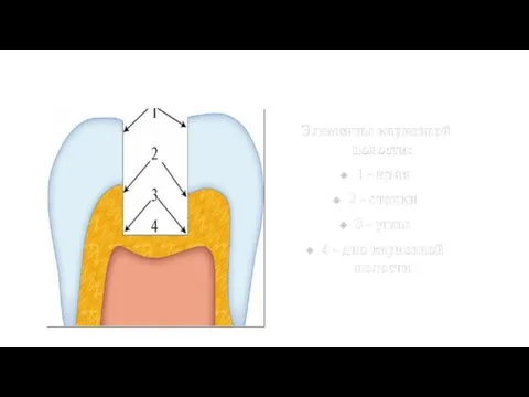 Элементы кариозной полости: 1 - края 2 - стенки 3