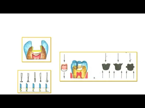 формируемые в стенке полости Разновидности опорно-фиксирующих пунктов при кариесе 1
