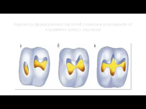 Варианты формирования полостей I класса в зависимости от поражения фиссур кариесом