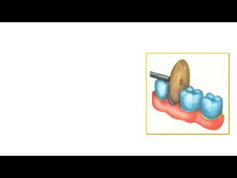 Сепарация зубов. Начальным этапом препарирова­ния полостей при тесном расположении зубов