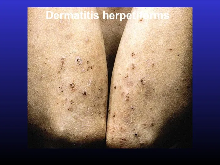 Dermatitis herpetiforms