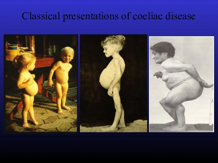 Classical presentations of coeliac disease