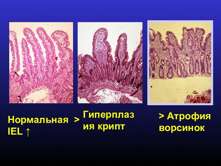 Нормальная > IEL ↑ Гиперплазия крипт > Атрофия ворсинок