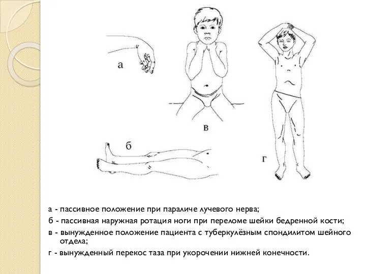 а - пассивное положение при параличе лучевого нерва; б -