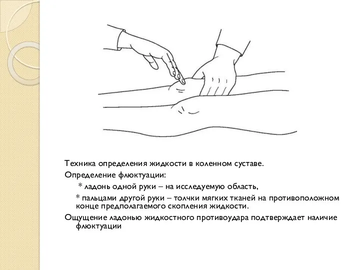 Техника определения жидкости в коленном суставе. Определение флюктуации: * ладонь