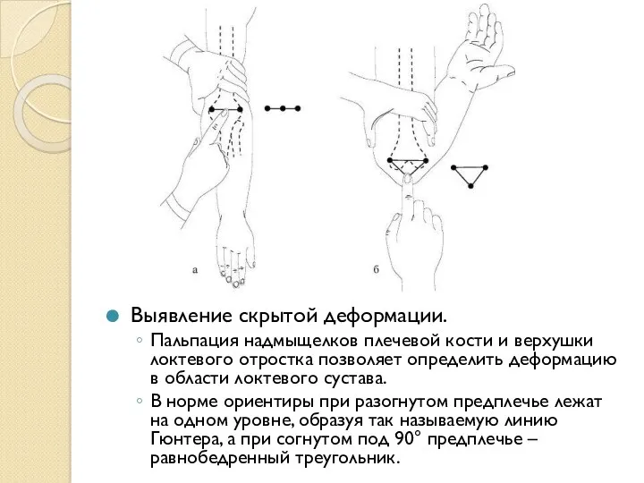 Выявление скрытой деформации. Пальпация надмыщелков плечевой кости и верхушки локтевого