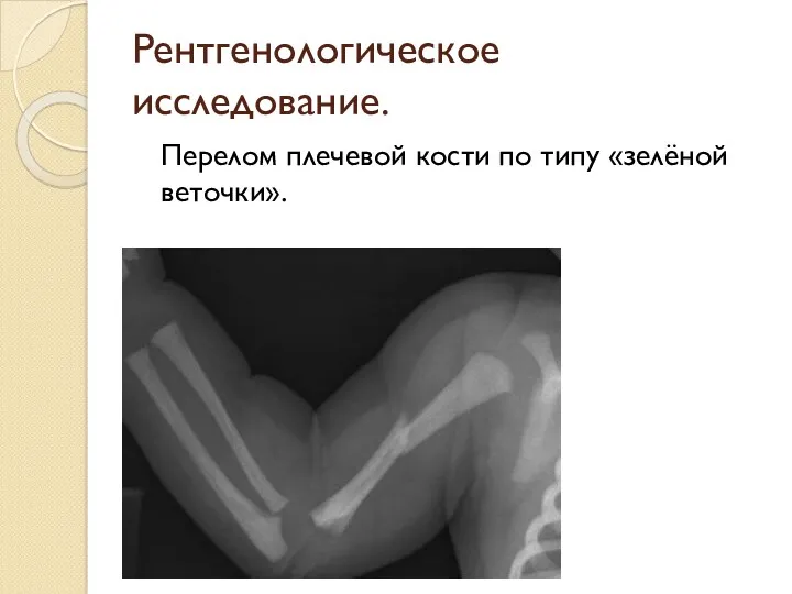 Рентгенологическое исследование. Перелом плечевой кости по типу «зелёной веточки».