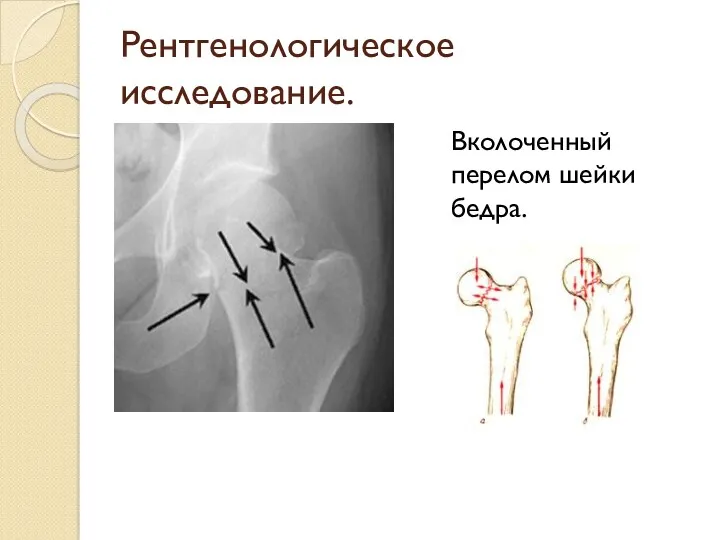 Рентгенологическое исследование. Вколоченный перелом шейки бедра.