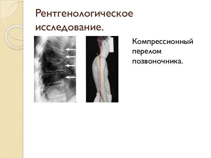 Рентгенологическое исследование. Компрессионный перелом позвоночника.