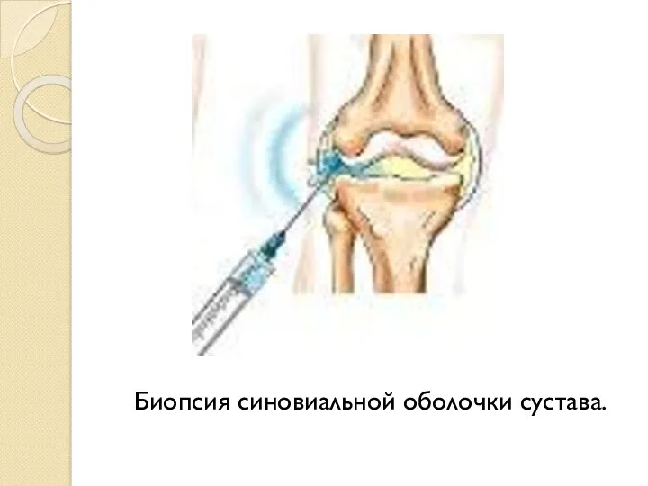 Биопсия синовиальной оболочки сустава.