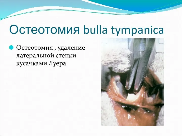 Остеотомия bulla tympanica Остеотомия , удаление латеральной стенки кусачками Луера