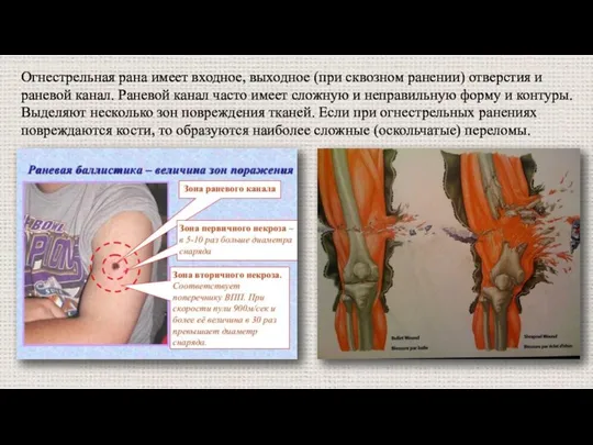 Огнестрельная рана имеет входное, выходное (при сквозном ранении) отверстия и