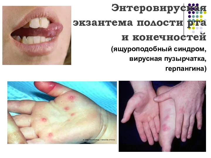 Энтеровирусная экзантема полости рта и конечностей (ящуроподобный синдром, вирусная пузырчатка, герпангина)