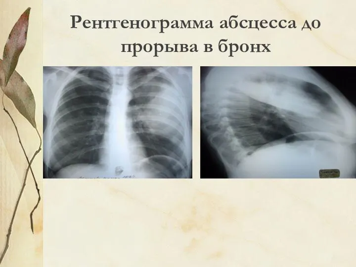 Рентгенограмма абсцесса до прорыва в бронх
