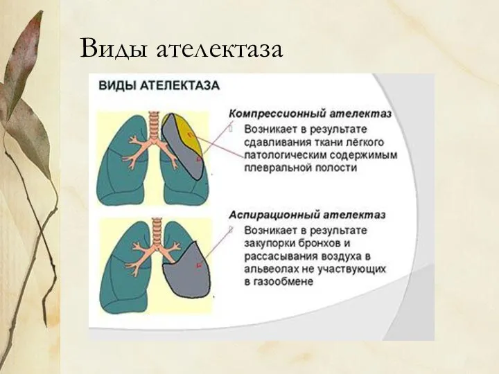 Виды ателектаза