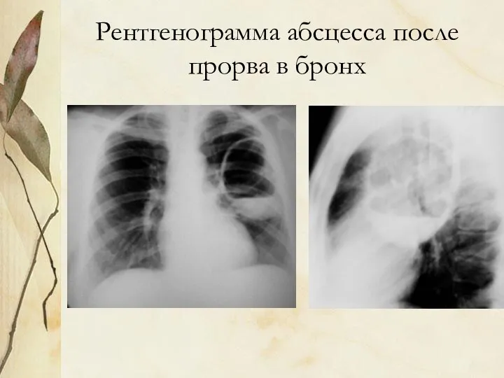 Рентгенограмма абсцесса после прорва в бронх