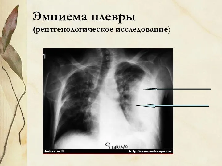 Эмпиема плевры (рентгенологическое исследование)