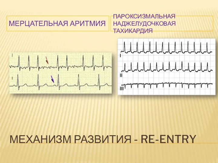 МЕХАНИЗМ РАЗВИТИЯ - RE-ENTRY МЕРЦАТЕЛЬНАЯ АРИТМИЯ ПАРОКСИЗМАЛЬНАЯ НАДЖЕЛУДОЧКОВАЯ ТАХИКАРДИЯ