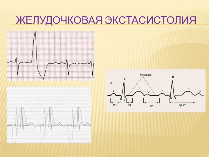 ЖЕЛУДОЧКОВАЯ ЭКСТАСИСТОЛИЯ