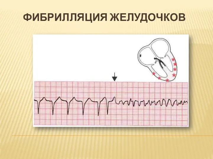 ФИБРИЛЛЯЦИЯ ЖЕЛУДОЧКОВ