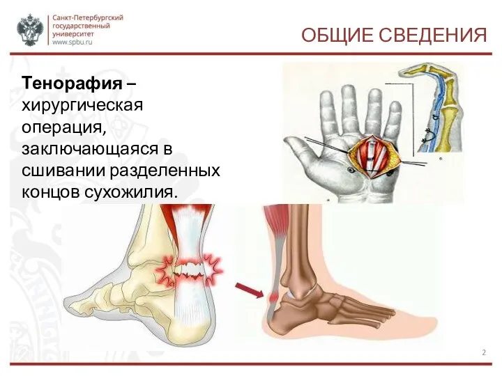 ОБЩИЕ СВЕДЕНИЯ Тенорафия – хирургическая операция, заключающаяся в сшивании разделенных концов сухожилия.