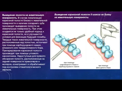 Выведение полости на жевательную поверхность. В случае локализации кариозной полости