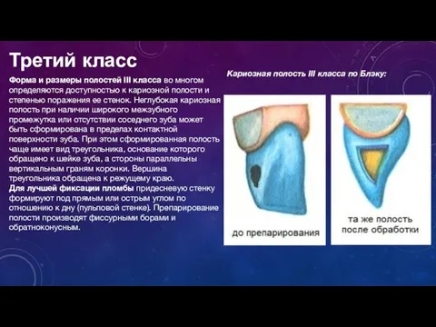 Третий класс Форма и размеры полостей III класса во многом